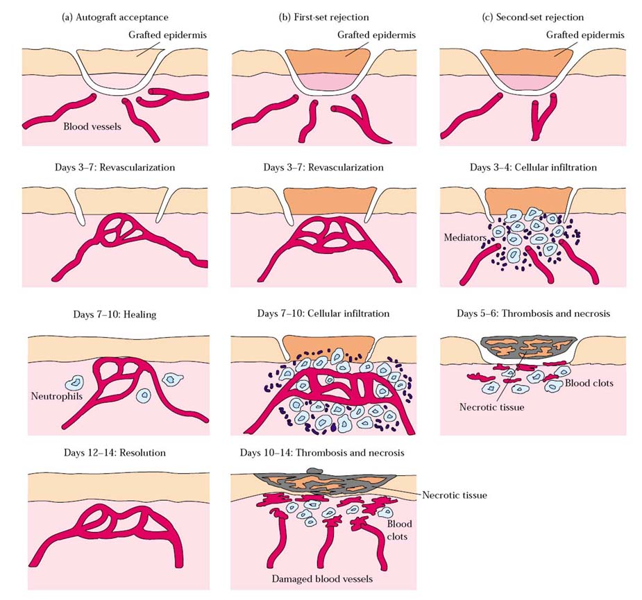 tissue rejection